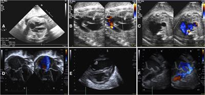 Vein of Galen aneurysmal malformation in newborns: a retrospective study to describe a paradigm of treatment and identify risk factors of adverse outcome in a referral center